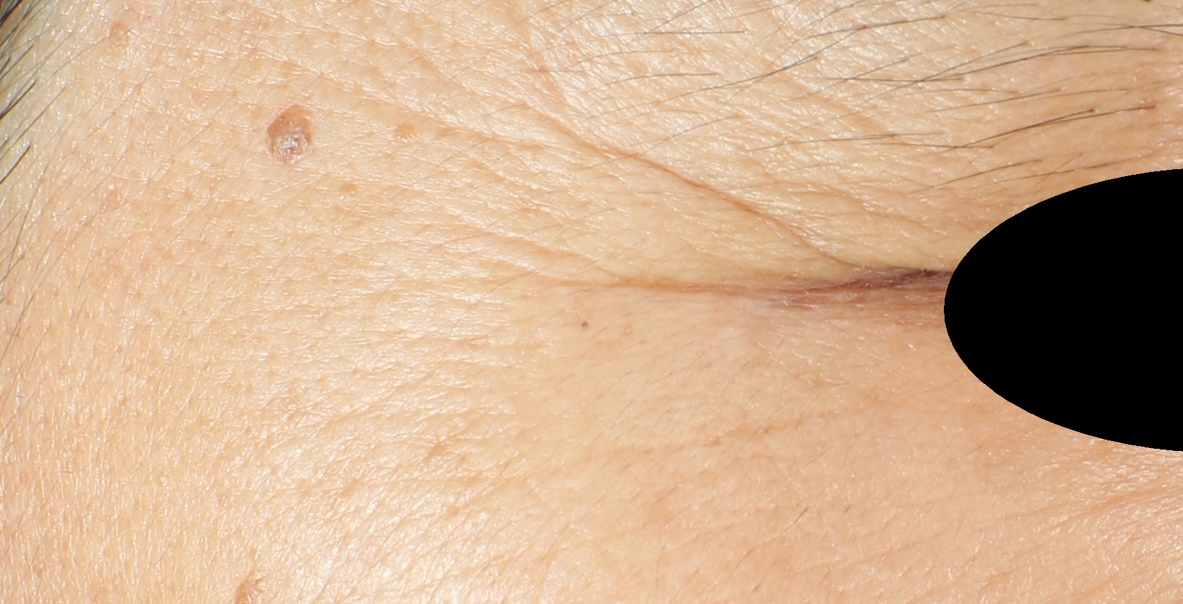 RETILANCE™ Wrinkle Depth improvement: Before