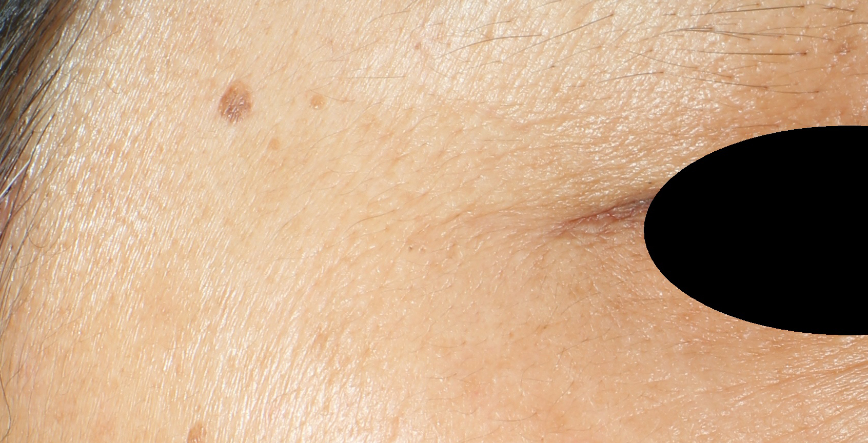 RETILANCE™ Wrinkle Depth improvement: After