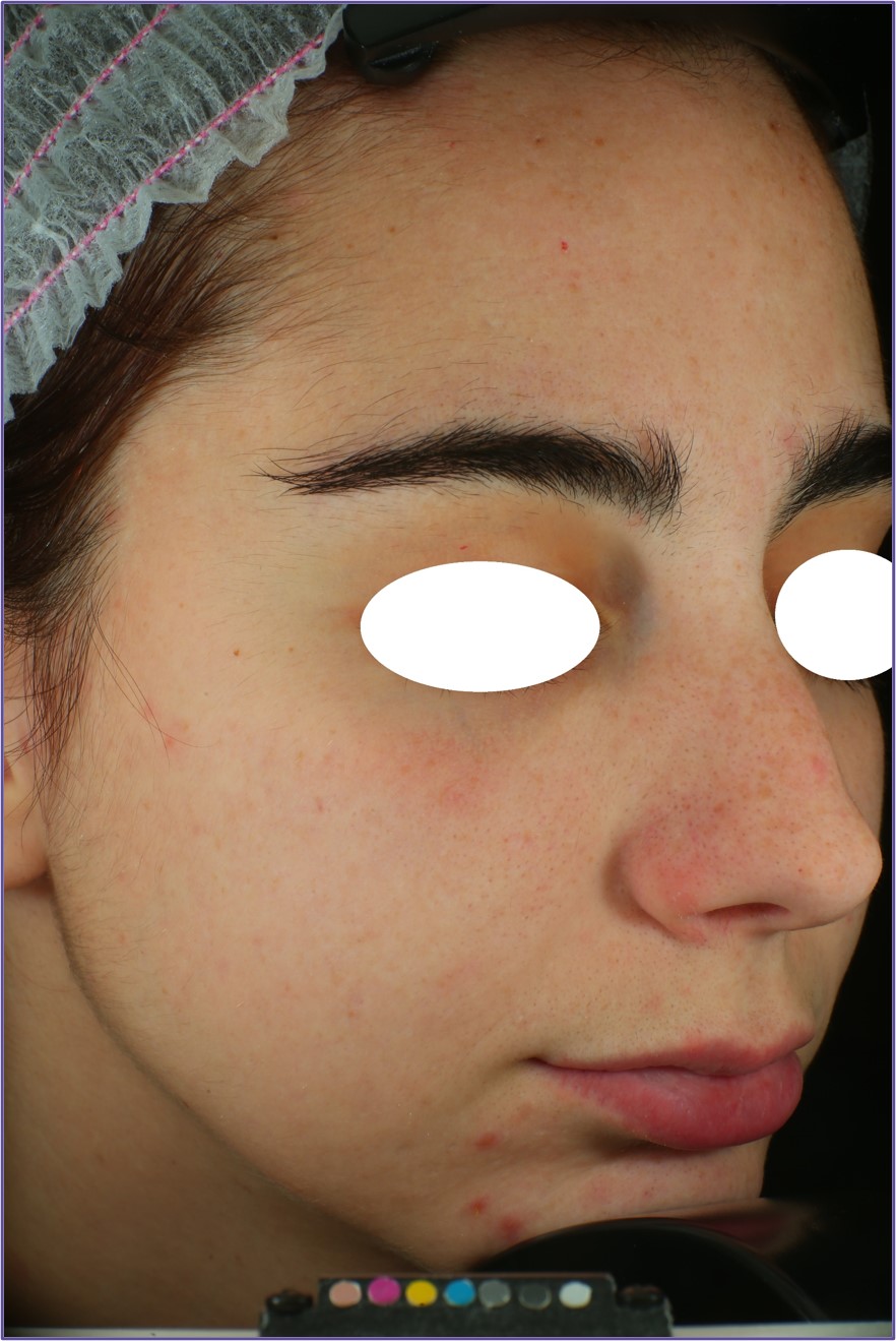 PUREBLOME™  Before