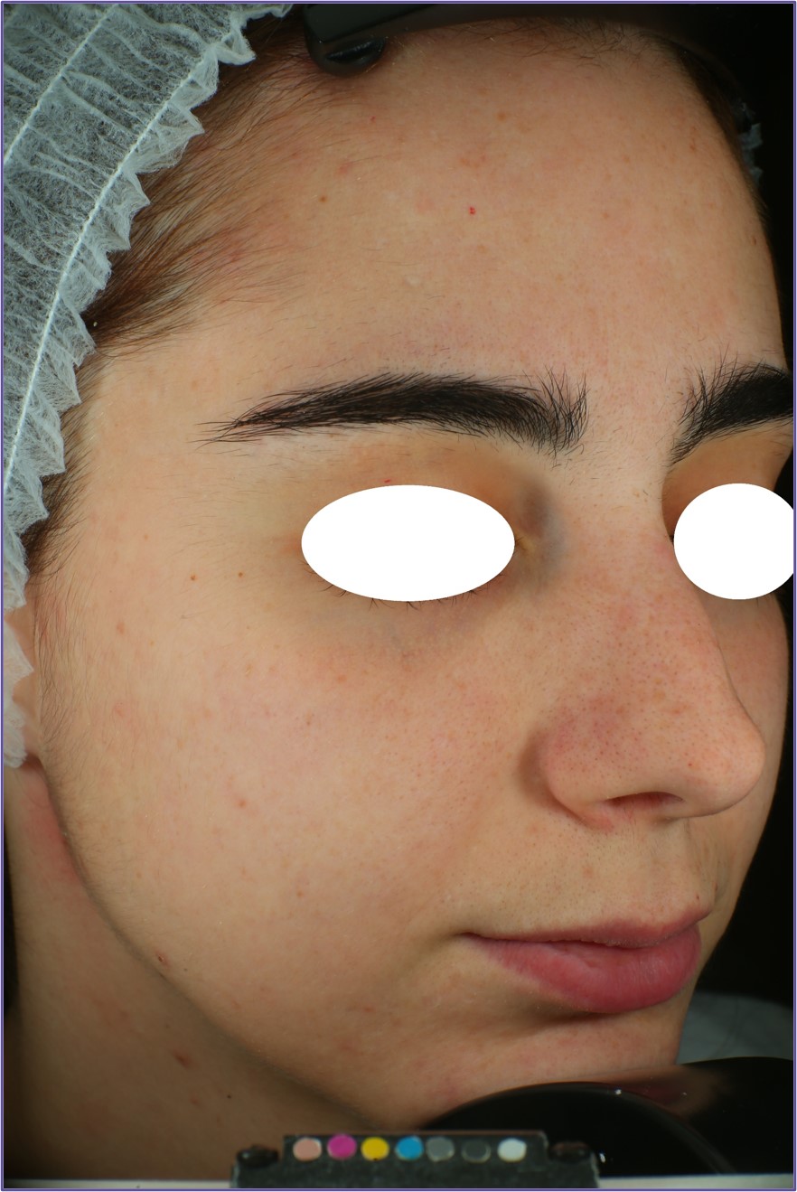 PUREBLOME™  After